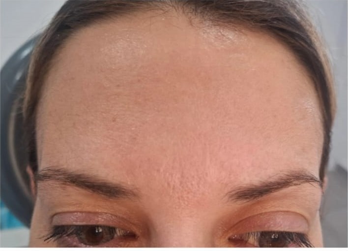 After: Botox — Forehead