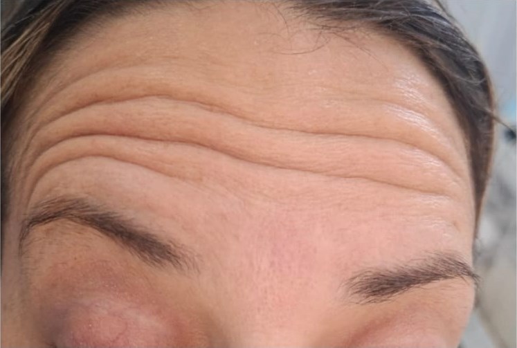 Before: Botox — Forehead