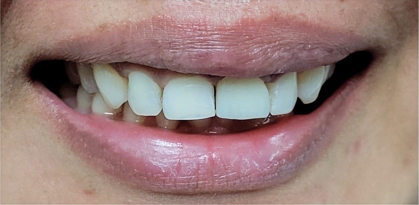 After: Composite Tooth Restoration