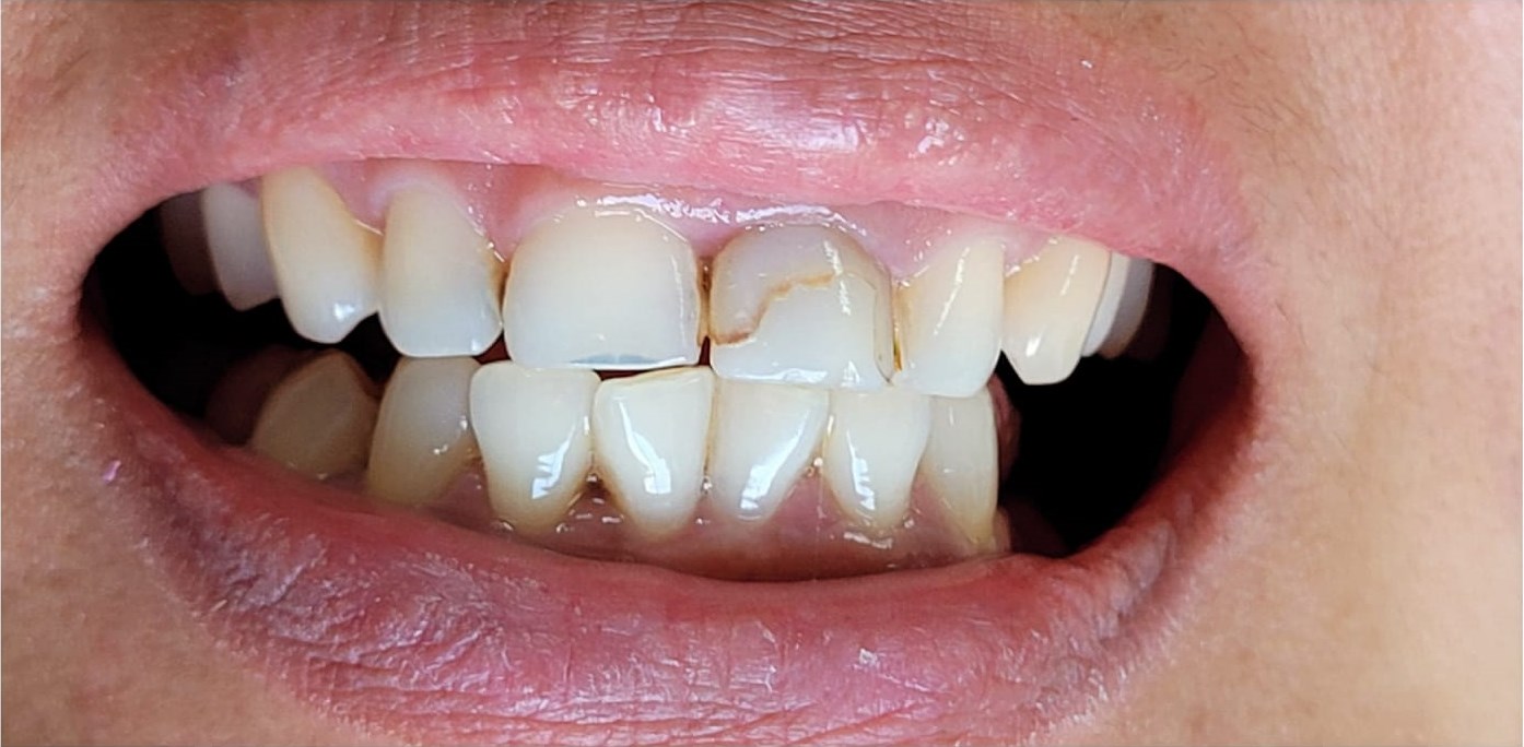 Before: Composite Tooth Restoration