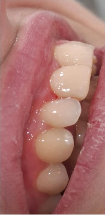 After: Composite Veneers