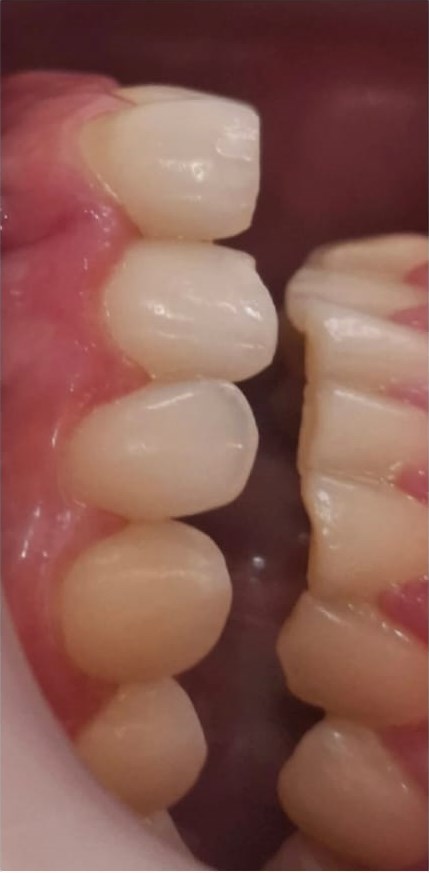 Before: Composite Veneers