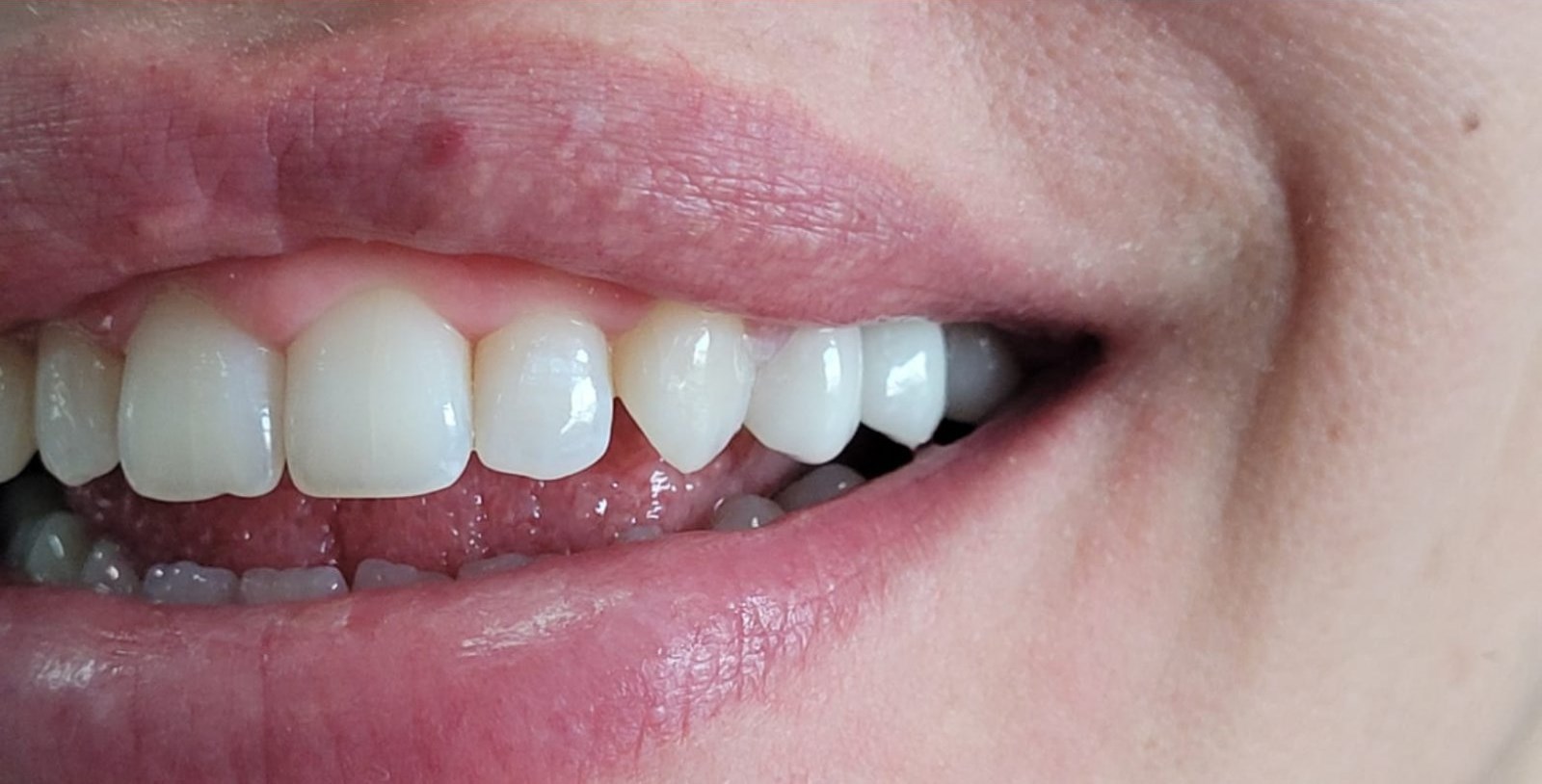 After: Dental Bridge