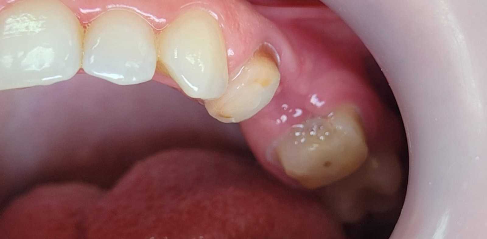 Before: Dental Bridge