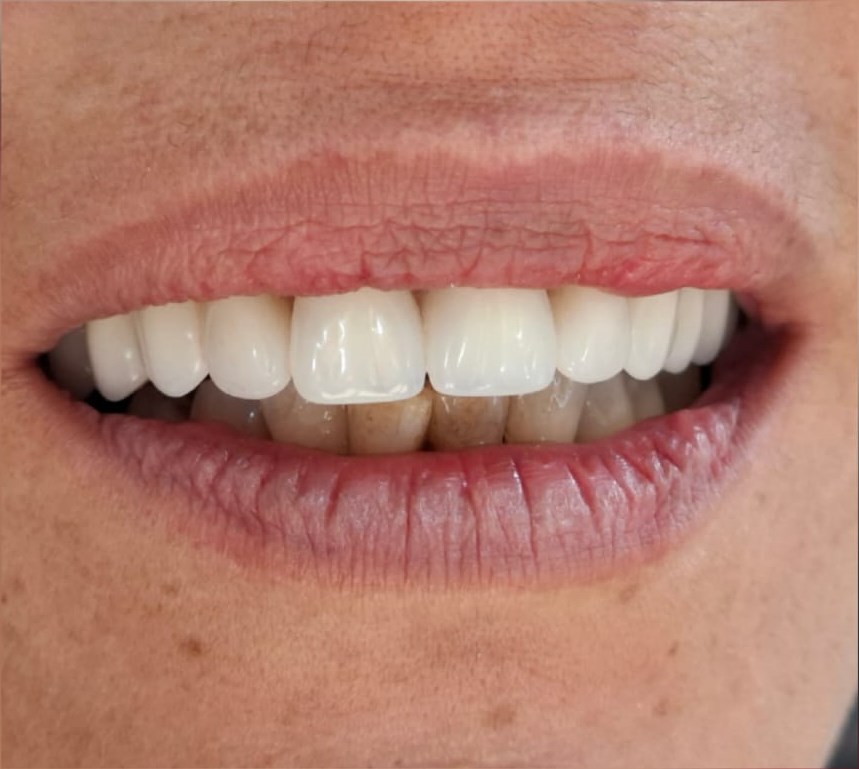 After: Denture Restoration