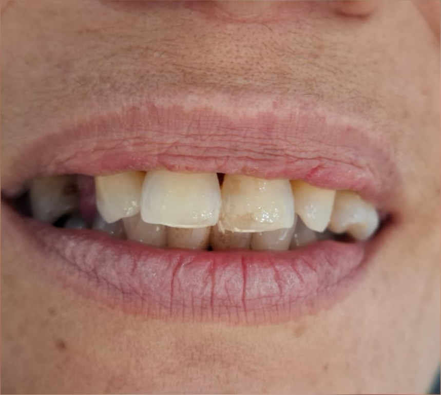 Before: Denture Restoration