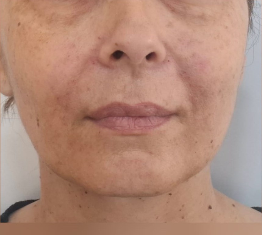 After: Hyaluronic Acid Facial Treatment