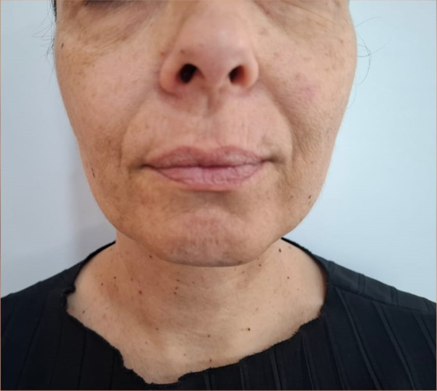 Before: Hyaluronic Acid Facial Treatment