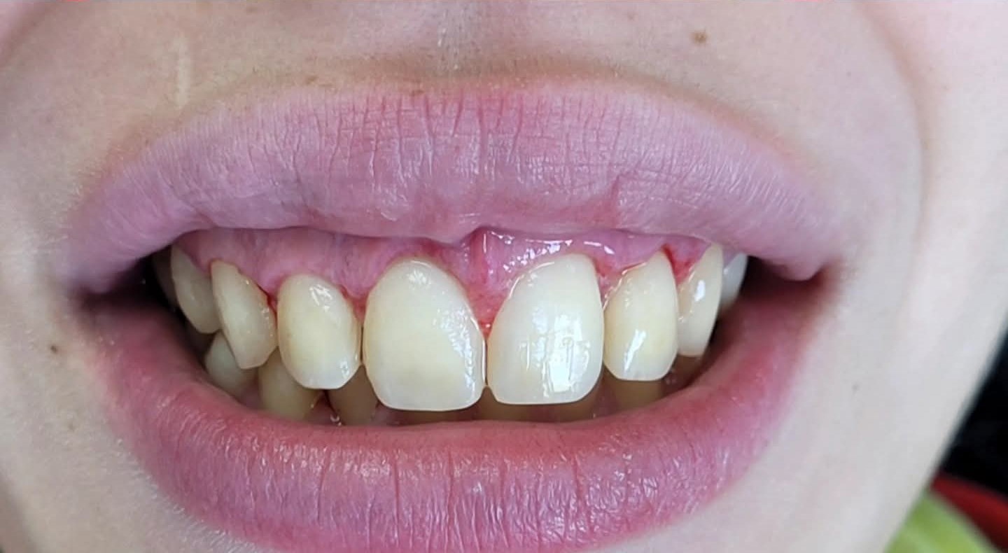 After: Gingivectomy