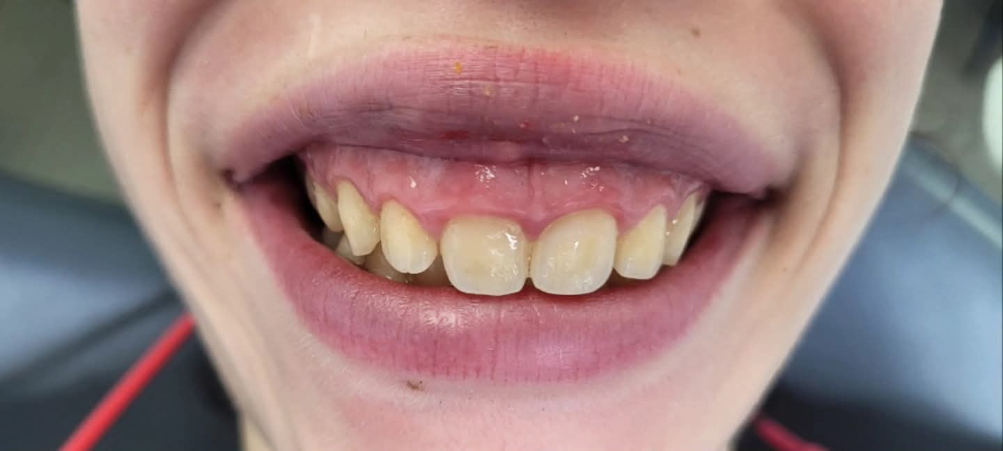 Before: Gingivectomy