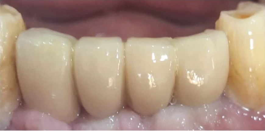 After: Implant-Supported Restoration