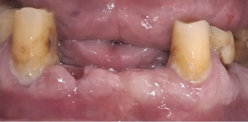 Before: Implant-Supported Restoration