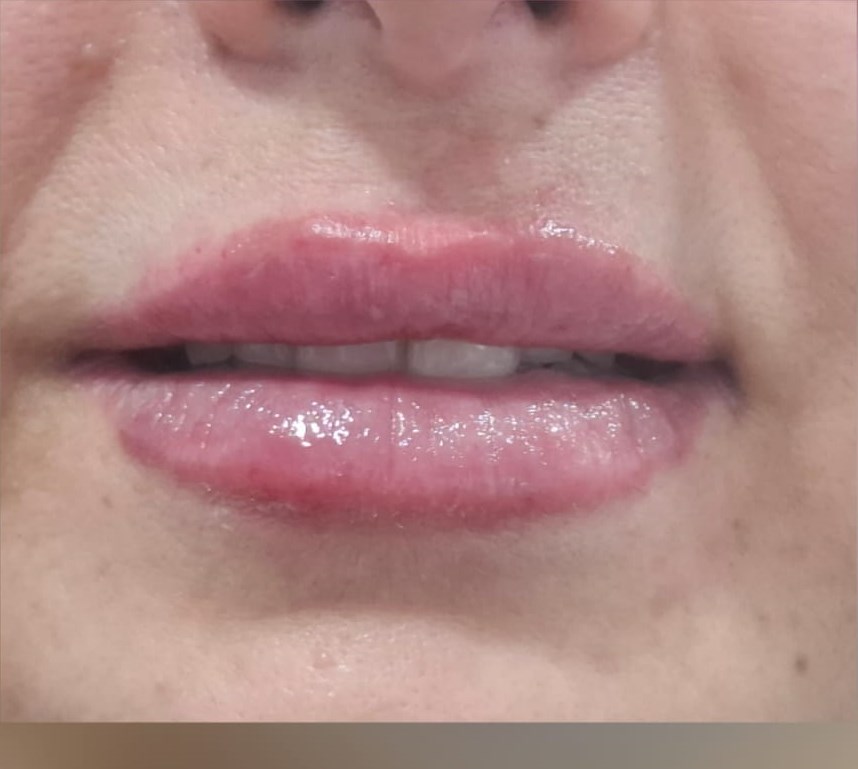 After: Lip Enhancement