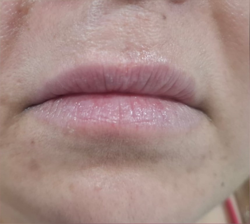Before: Lip Enhancement