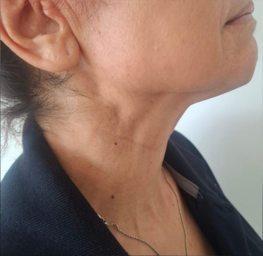 After: Neck Aesthetic Treatment