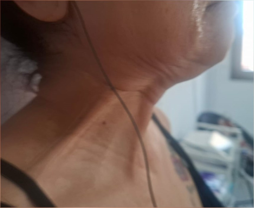 Before: Neck Aesthetic Treatment
