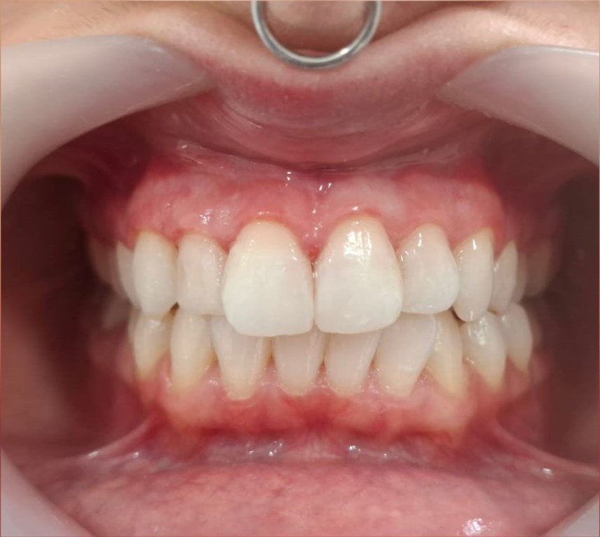 After: Teeth Whitening