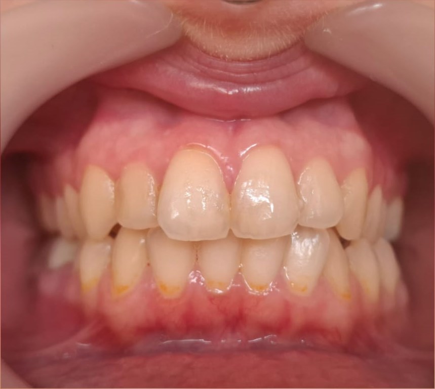 Before: Teeth Whitening