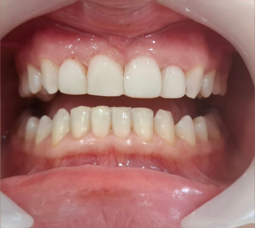After: Composite Veneers & Whitening