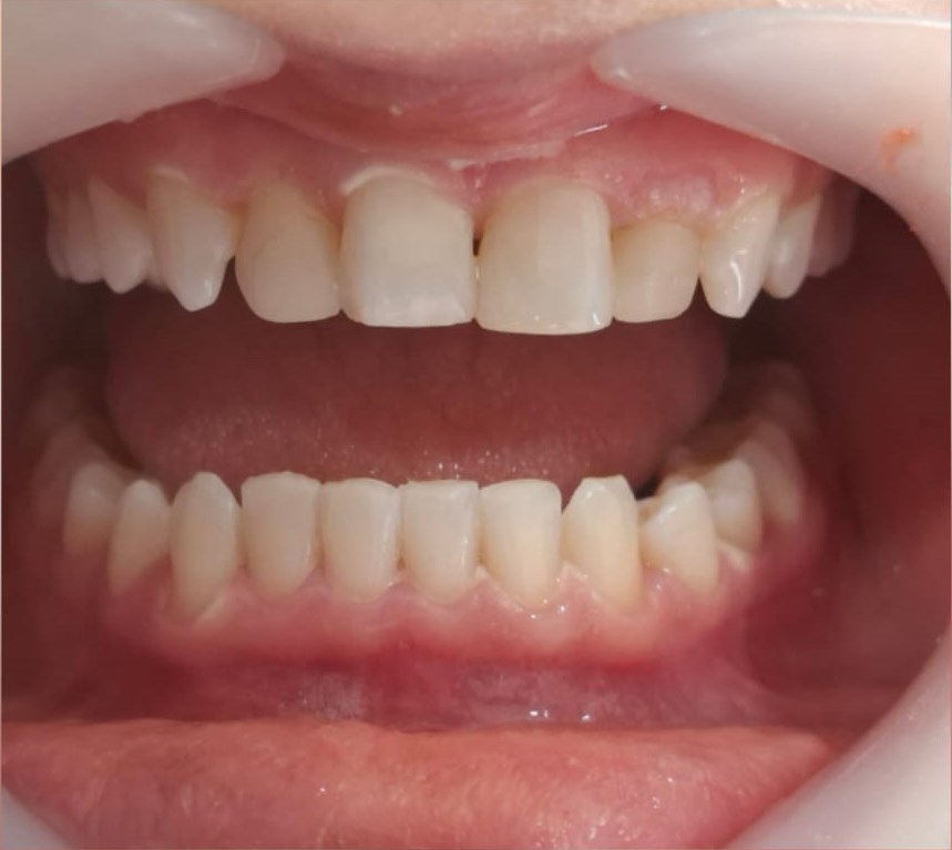 Before: Composite Veneers & Whitening