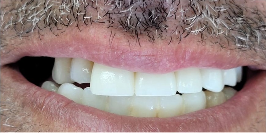 After: Zirconia Restoration