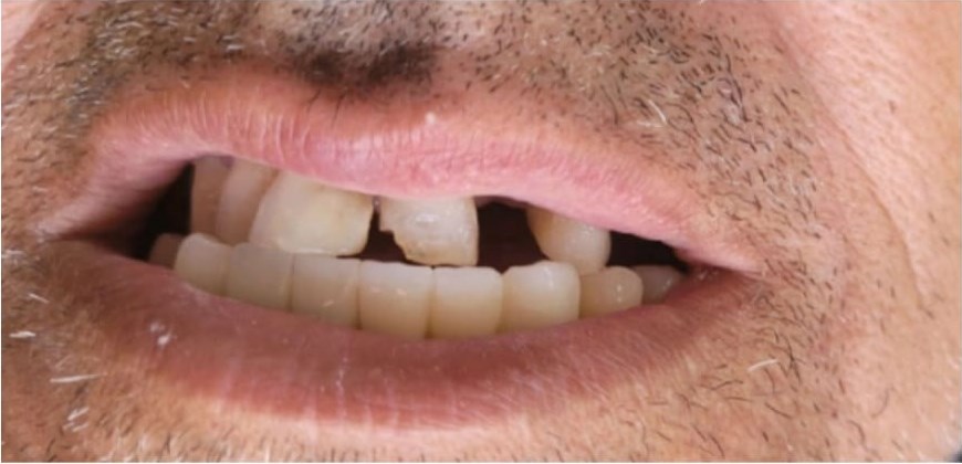 Before: Zirconia Restoration